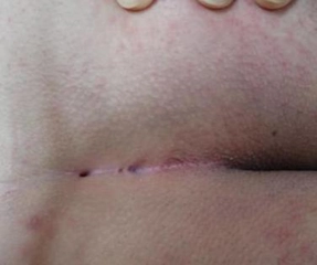 Makat Hastalıkları Belirtileri ve Tedavisi